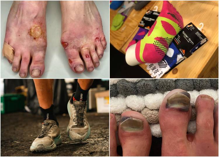 Η Φροντίδα των Ποδιών στις Υπεραποστάσεις: Πρόληψη, Εμπειρία και Νοοτροπία (Δεύτερο Μέρος)!